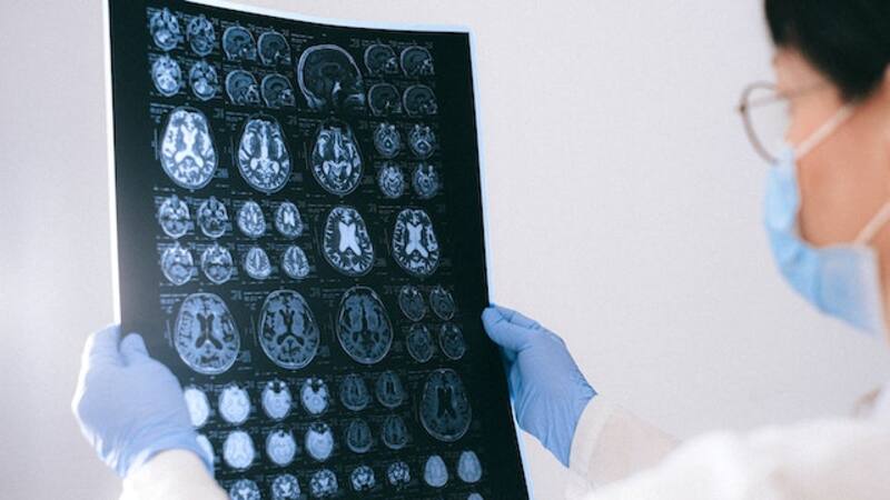 Estos síntoma de Parkinson pueden aparecer 20 años antes del diagnóstico y algunos son muy comunes.