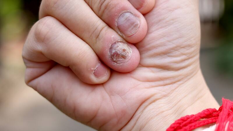 Las autoridades sanitarias recomiendan extremar precauciones y reportar cualquier reacción, mientras instan a los fabricantes a revisar sus formulaciones.