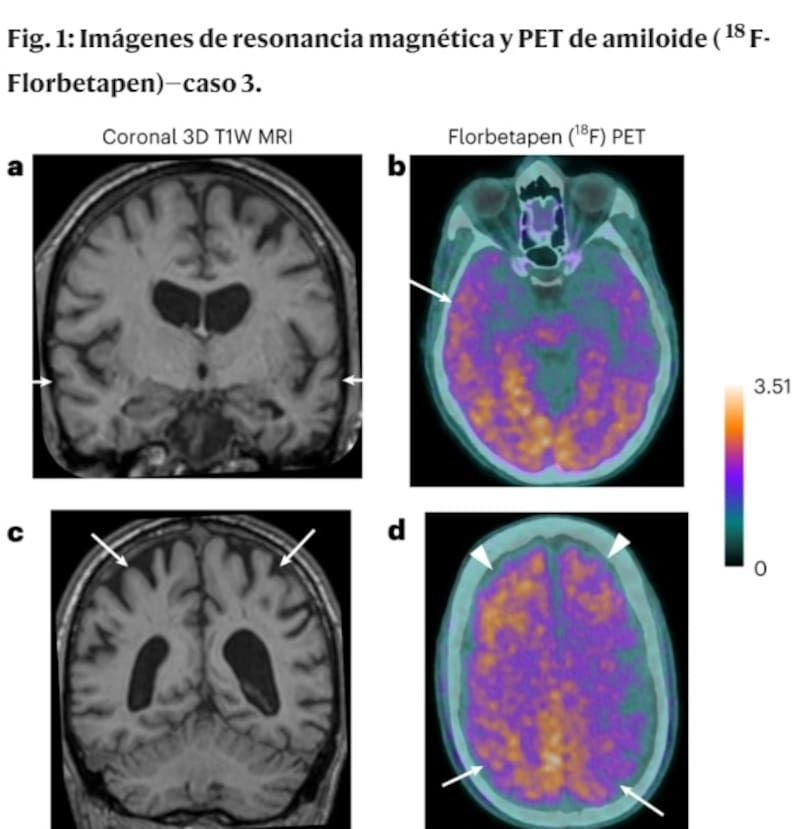 Resonancia magnética cerebral. Fuente: Nature.