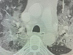 Las 4 fotos del coronavirus que meten miedo: cómo avanza la enfermedad en los pulmones