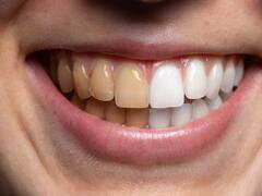 Chau dientes amarillos: la mezcla mágica para quitar el sarro y blanquear la sonrisa