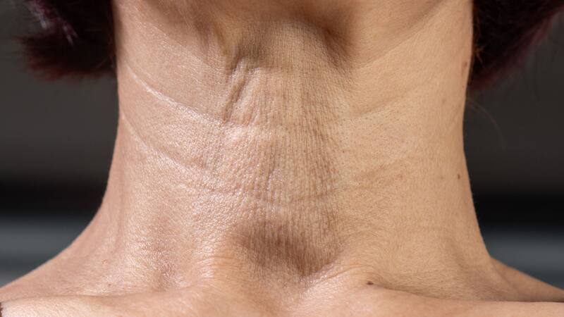 Adiós arrugas: los mejores remedios caseros para retrasar el envejecimiento y disminuir lineas de expresión.