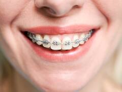 Brackets en Argentina: cuánto cuestan en julio de 2025