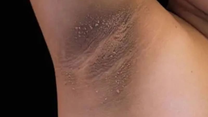 La acantosis nigricans es el primer síntoma antes de los más comunes. Foto (archivo)