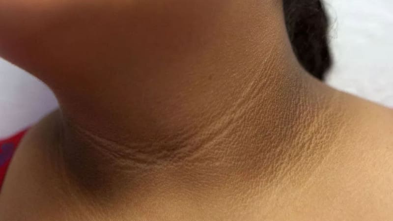 La acantosis nigricans es el primer síntoma antes de los más comunes. Foto (archivo)