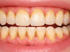 Por esta razón el sarro se adhiere a tus dientes | El truco para evitar que siga creciendo y acabe con tu salud bucal