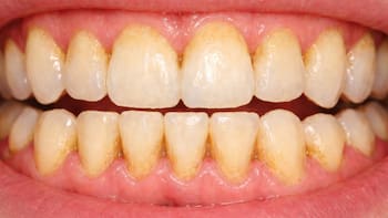 Por esta razón el sarro se adhiere a tus dientes | El truco para evitar que siga creciendo y acabe con tu salud bucal