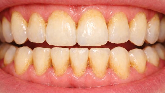 Por esta razón el sarro se adhiere a tus dientes | El truco para evitar que siga creciendo y acabe con tu salud bucal
