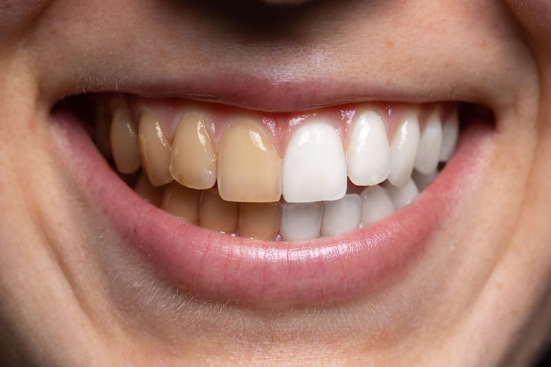 Mezclar bicarbonato de sodio con agua y sal: para qué sirve y por qué recomiendan hacerlo si tenés los dientes amarillos