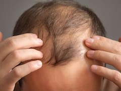 El hábito de alimentación que podría estar relacionado con la caída del cabello, según un estudio