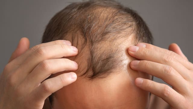 El hábito de alimentación que podría estar relacionado con la caída del cabello, según un estudio