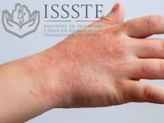 Virus Coxsackie en México: el Gobierno emite alerta por la infección que afecta a bebés y niños pequeños