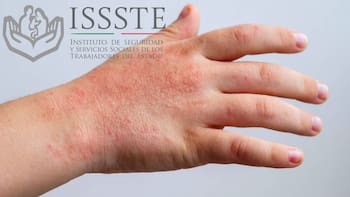 Virus Coxsackie en México: el Gobierno emite alerta por la infección que afecta a bebés y niños pequeños