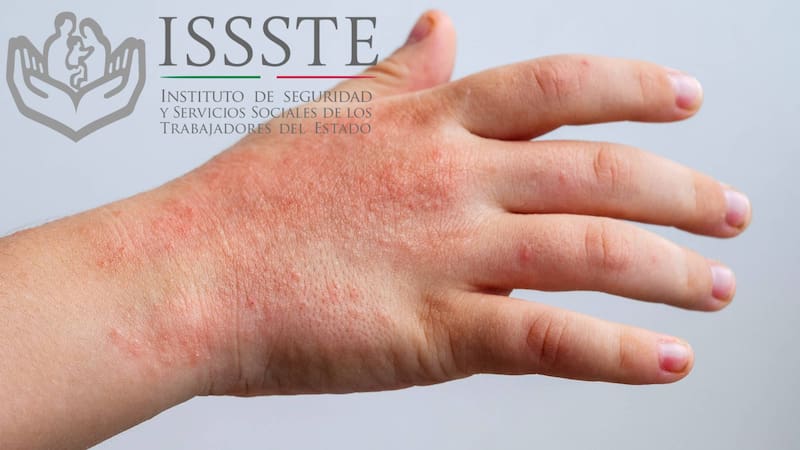 Autoridades advierten sobre el aumento de casos de virus Coxsackie en menores. El ISSSTE llama a reforzar la higiene y detectar síntomas a tiempo.