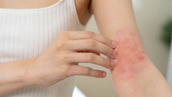 El estrés da dermatitis: por qué los científicos advierten que tu piel puede empeorar bajo presión y qué ocurre en el cuerpo