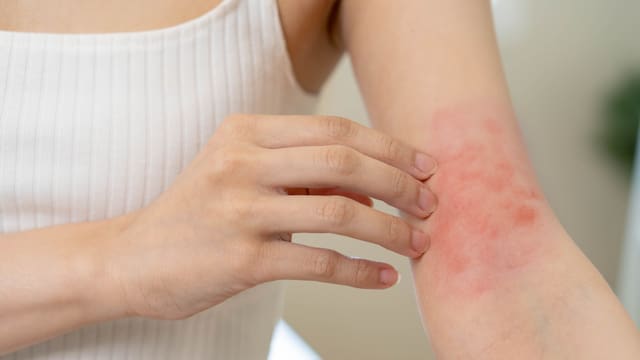El estrés da dermatitis: por qué los científicos advierten que tu piel puede empeorar bajo presión y qué ocurre en el cuerpo