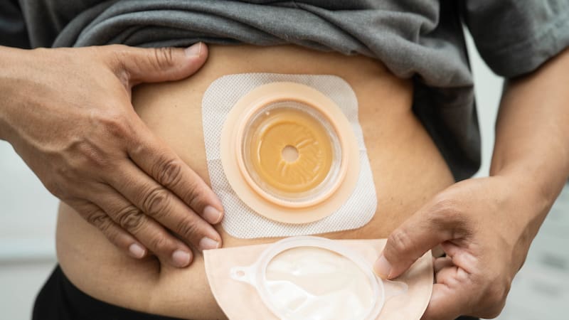 PAMI: guía paso a paso para solicitar las bolsas y discos de colostomía, ileostomía y urostomía