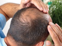 La respuesta fácil y rápida para la calvicie: este es el remedio casero que ayuda a prevenir la caída del cabello