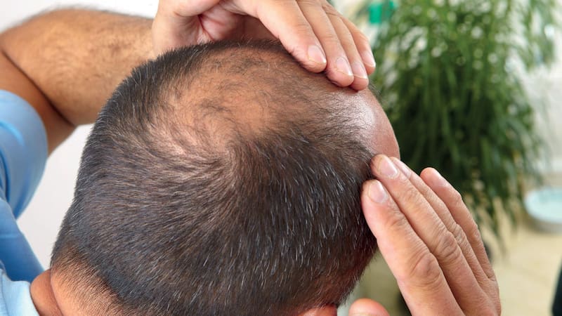 Este remedio casero ayuda a mejorar la fortaleza del cabello y evitar la caída.