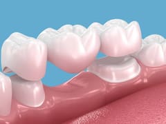 Prótesis parciales removibles o prótesis fijas: la opción dental que más conviene según tu caso