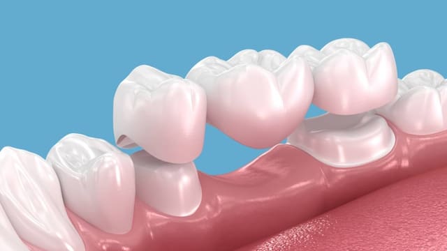 Prótesis parciales removibles o prótesis fijas: la opción dental que más conviene según tu caso