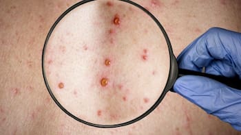 ¿Alerta por una nueva pandemia? Una variante de la viruela del mono irrumpe en Europa y los gobiernos temen lo peor