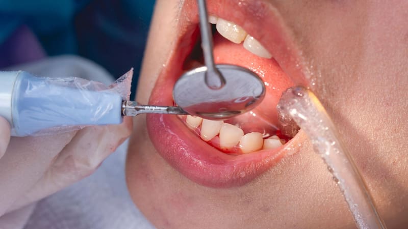 Estos remedios funcionan principalmente como preventivos, no como sustitutos de una limpieza profesional.