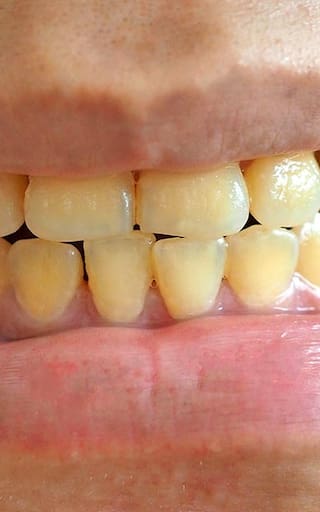 Ni vinagre ni bicarbonato: este es el mejor truco para eliminar el sarro de los dientes