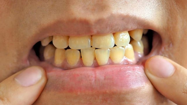 Ni vinagre ni bicarbonato: este truco es el mejor para eliminar el sarro de los dientes