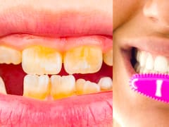 Las caries no son lo que siempre se creyó: el análisis científico que contradice lo que afirman los dentistas