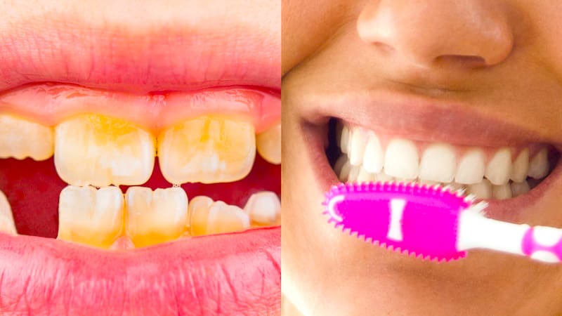 Caries en los dientes