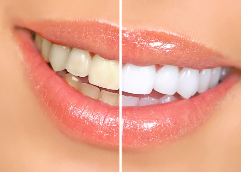 Limpieza dental