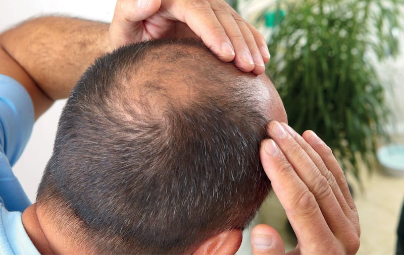 El país que incluirá tratamientos contra la caída del pelo en su seguro médico.