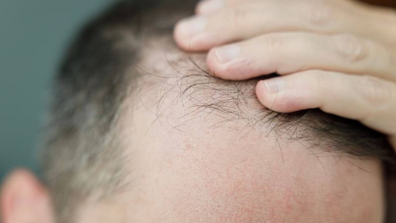 El primer país que incorpora los tratamientos contra la caída del cabello en el seguro médico nacional.