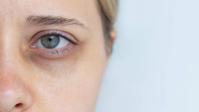 Enfriar cucharas en la heladera y aplicarlas sobre los párpados puede mejorar el aspecto de las ojeras.