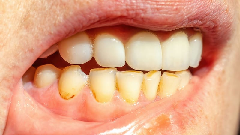 Ni bicarbonato ni limón: la manera ideal de sacar el sarro de los dientes sin pasar por el dentista
