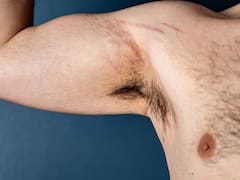 Estrías en hombres: por qué aparecen, la causa que muchos pasan por alto, y cómo tratarlas