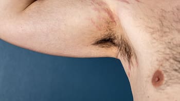 Estrías en hombres: por qué aparecen, la causa que muchos pasan por alto, y cómo tratarlas