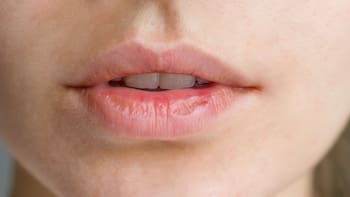 Se despiden los labios secos por el viento, calor o frío: remedios caseros naturales para hidratar y potenciar tu boca