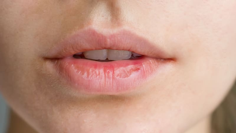 Existen remedios naturales que pueden curar los labios resecos.