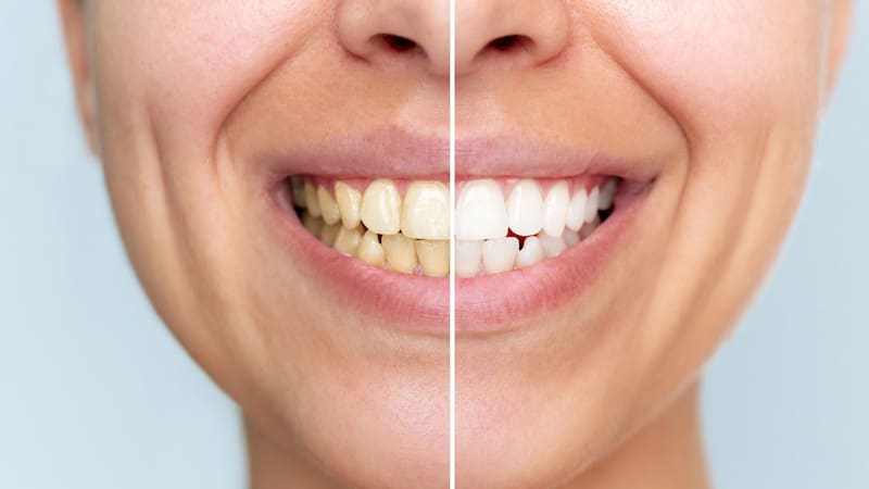 Fin de las manchas amarillas | La mezcla casera y libre de químicos para blanquear los dientes y dejarlos brillantes
Fuente: Shutterstock