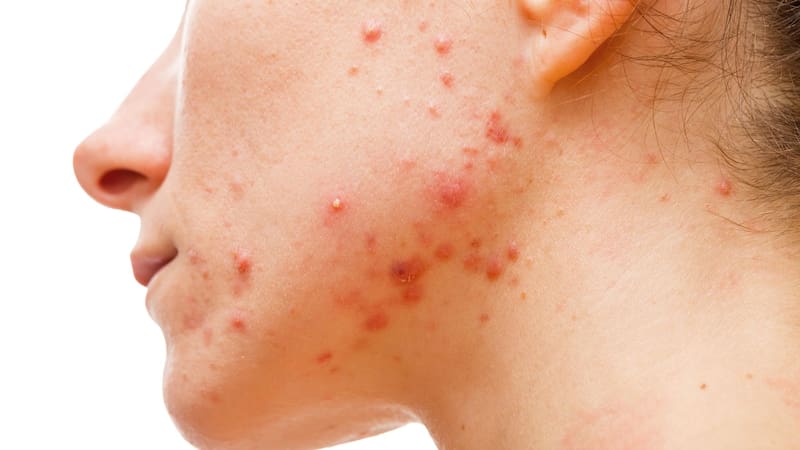 El ingrediente secreto que todos tienen en casa y que transforma la piel (Fuente: medlineplus).