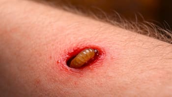 Alarma sanitaria | Una plaga erradicada hace seis décadas está regresando a Estados Unidos: se retuerce en la carne viva y se alimenta de ella