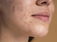 Remedios naturales para el acné: el ingrediente secreto que todos tienen en casa y que transforma la piel