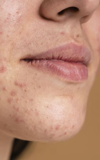 Remedios naturales para el acné: el ingrediente secreto que todos tienen en casa y que transforma la piel