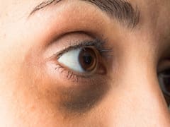 Adiós a las ojeras: remedios naturales para eliminar para siempre con la mirada cansada