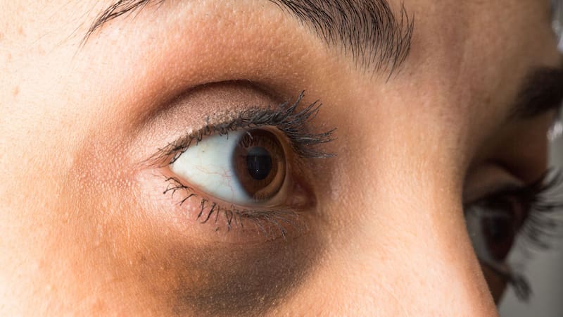 Adiós a las ojeras: remedios naturales para eliminar para siempre con la mirada cansada.