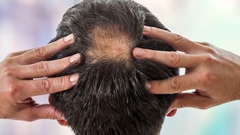 El fin de la calvicie: este es el tratamiento casero que evita la caída del cabello