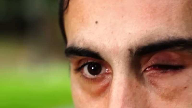 Así quedó el ojo de Julián Nieto (Foto: Morir en guerra ajena)