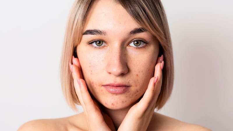 La combinación de bacterias, calor, fricción y suciedad termina afectando la barrera natural de la piel.